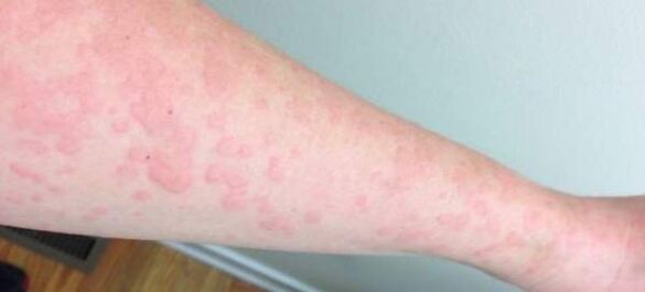 Kožne alergije znak su prisutnosti parazita u tijelu